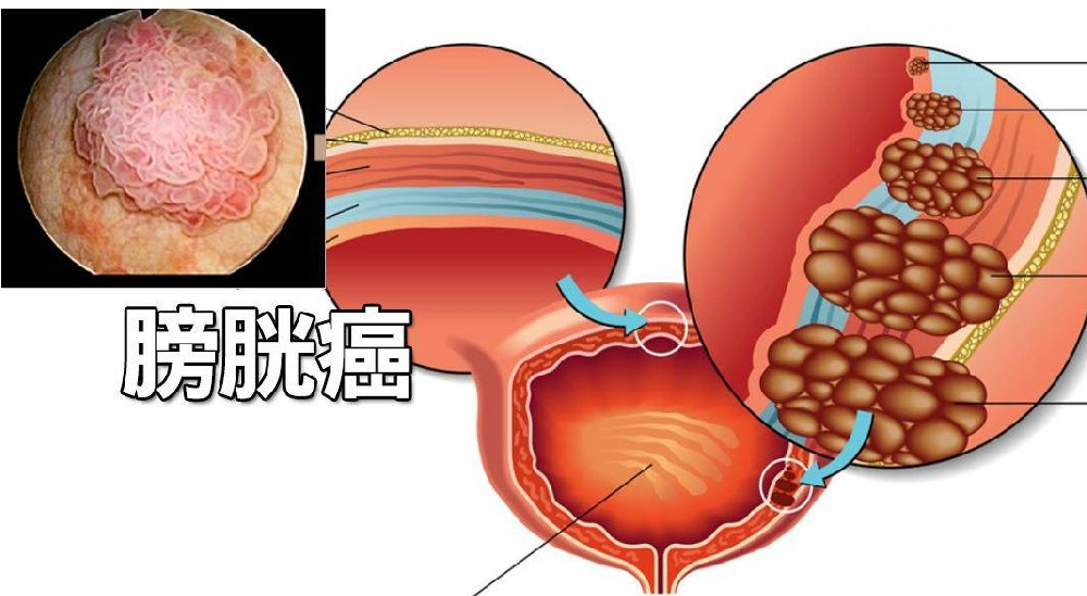 广州中医可以根治膀胱癌吗