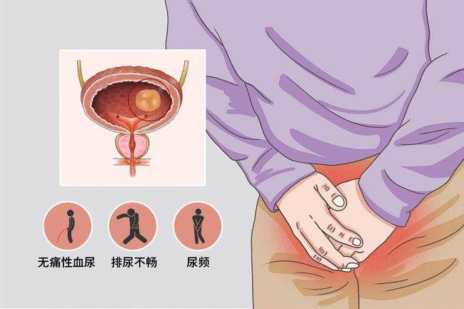 广州中医治疗膀胱癌会复发吗