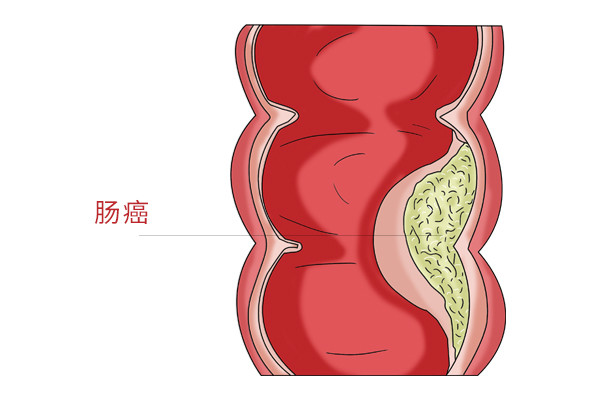 广州中医直肠癌治疗效果