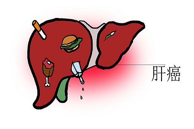 广州肿瘤科医院案例|张老先生肝硬化的中医治疗之路