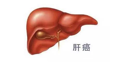 广州肿瘤专科医院科普|中医治疗肝癌效果为何这么好?不同症状辩证治疗