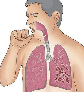 广州治疗肺癌医院排名|很少吸烟的女性肺癌发病率竟然高于男性