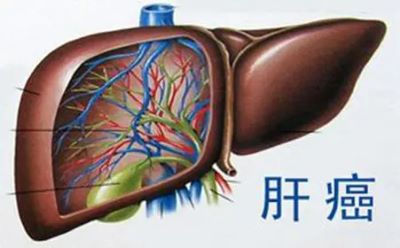 广州中医肝癌专家:你了解肝癌的诱发因素吗,快来看看