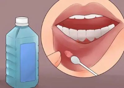 广州中医治疗口腔癌有名的老中医:口腔癌常见症状表现有哪些