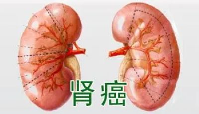 广州中医肿瘤专家:哪类人易患肾癌,肾癌为什么会复发
