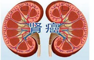 广州中医肿瘤科医院科普|这3个原因竟会引发肾癌