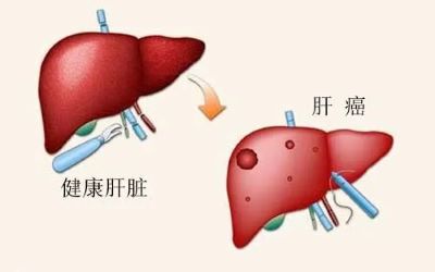 广州治疗肝癌老中医:乙肝会转变成肝癌吗