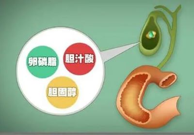 广州治疗胆管癌老中医:带你了解胆管癌的症状表现和特征