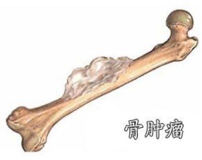 你以为的“生长痛”,还有可能是骨癌！