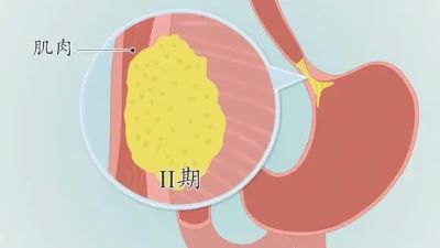 广州中医肿瘤科医院科普|贲门癌各期症状有哪些