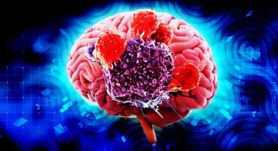 广州肿瘤医师:脑瘤只能手术治疗?其实中医治疗有独特的优势