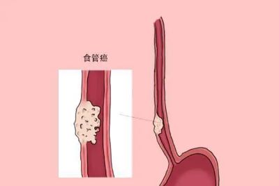 广州中医专家:关于食管癌你了解多少呢?平时该如何自查呢