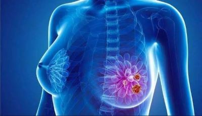 广州乳腺癌中医医师:发现乳腺肿瘤,这些异常需留心