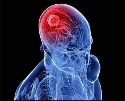 脑瘤患者头痛一年有余是何原因?中医角度告诉你答案