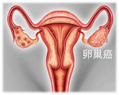 老中医张忠民:中医辨证施治传承研究卵巢癌疗法