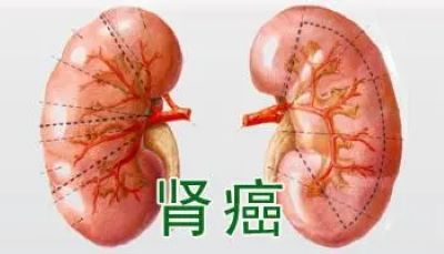 当生活中出现这些症状小心是肾癌悄悄上门了