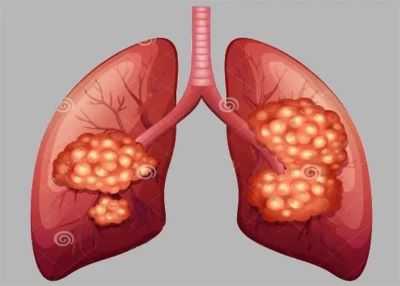 得了肺癌究竟是种什么体验?中医可以治疗吗