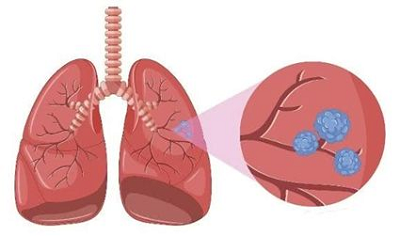为什么肺癌容易发生脑转移?广州治疗肺癌老中医解答