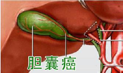 广州中医院治疗胆囊癌效果好不好?