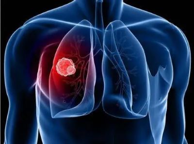 肺癌患者为什么会胸闷气短,呼吸困难?广州老中医解答