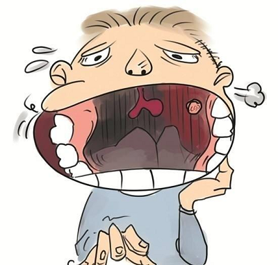 广州哪老中医治疗口腔癌好