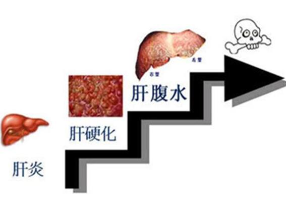 治疗肝癌腹水