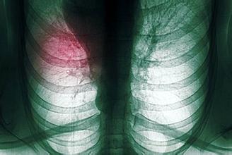 肺癌的分型