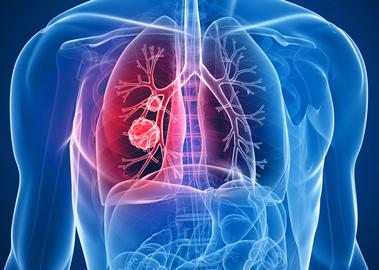 环境差也能诱发肺癌？了解诱发肺癌的5个因素