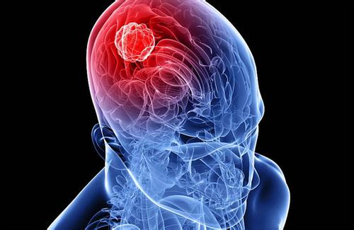 脑瘤的早期有什么症状表现？这9点要注意