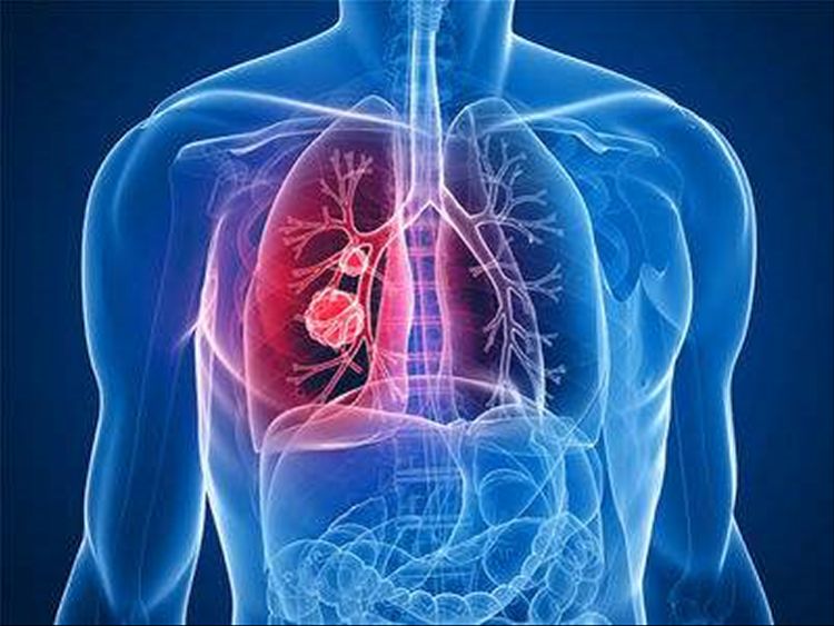 肺癌的发生与日常饮食有关系吗？这3点要重视