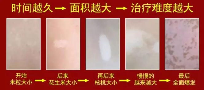 白癜风不扩散是病情好转